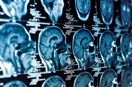 Atlanta Head or Brain Injury Attorney